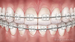 Clear braces