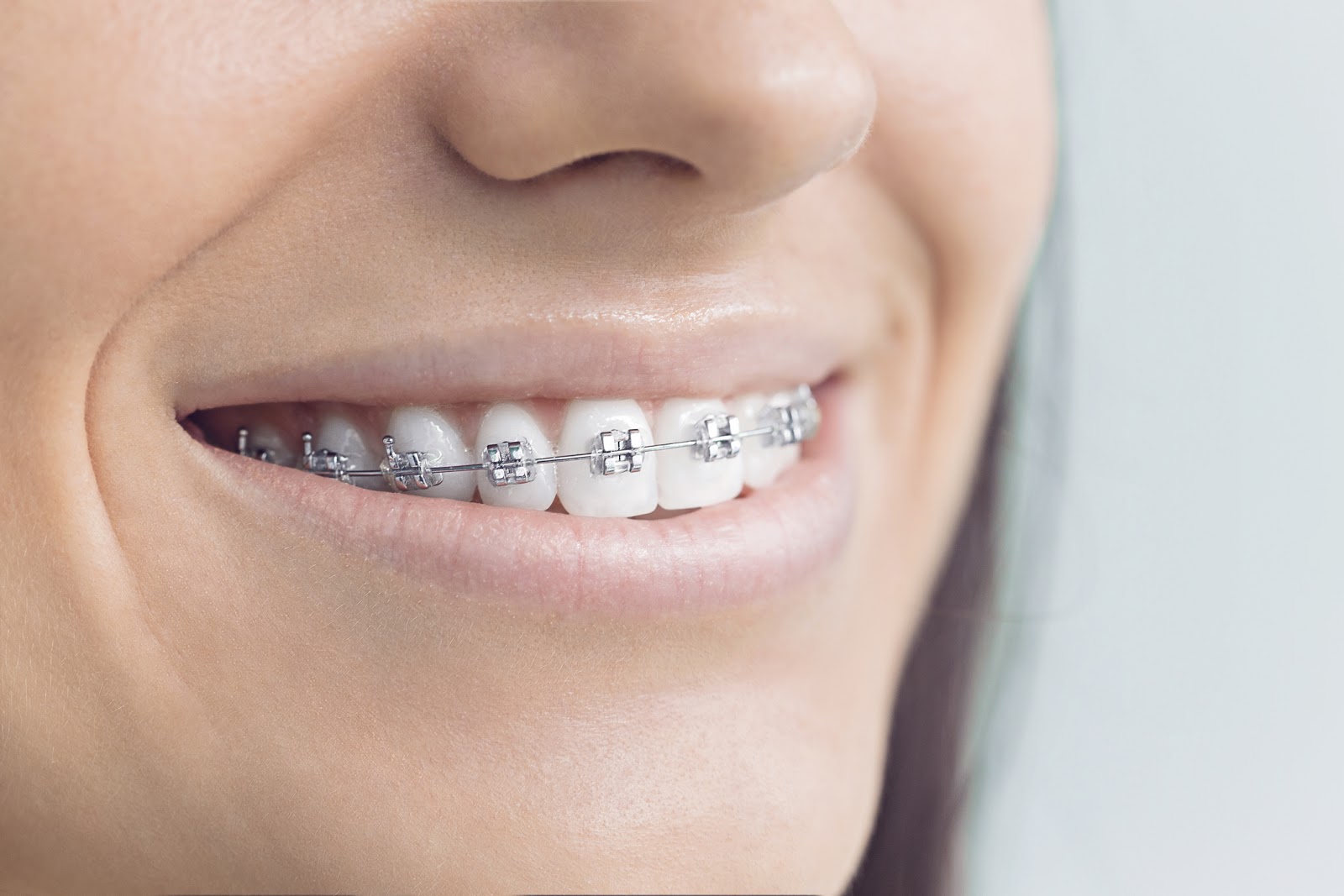 Smiling woman wearing Damon metal braces